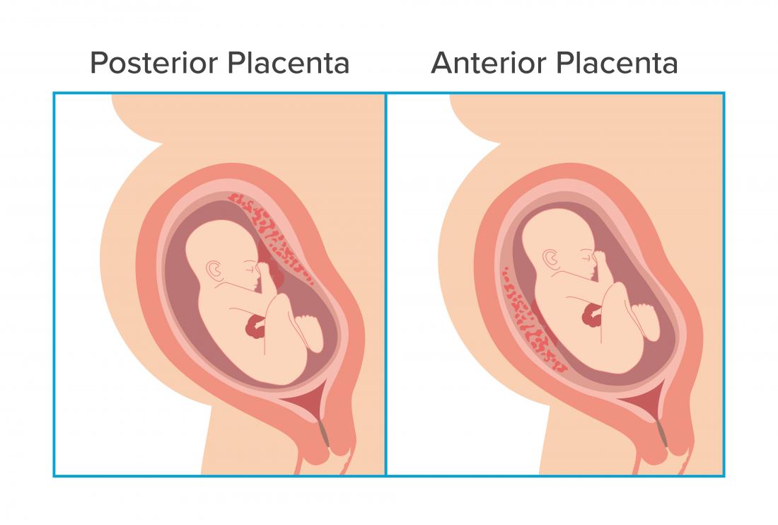 Placenta Location