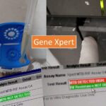 Sample Genexpert MTB/RIF Report Format for TB Diagnosis