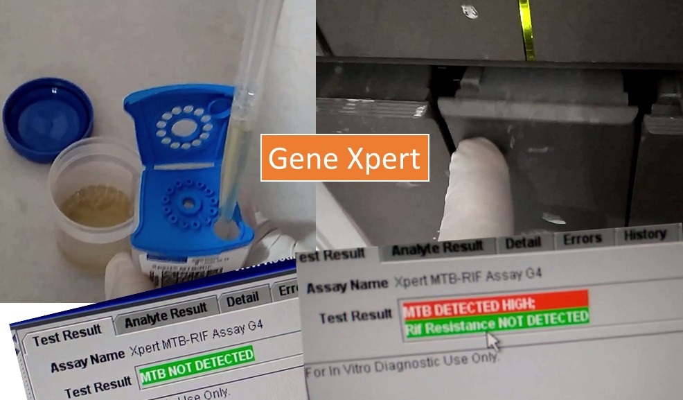 Sample Genexpert MTB/RIF Report Format for TB Diagnosis