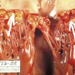 What is acute bacterial endocarditis, and what are its common causes?