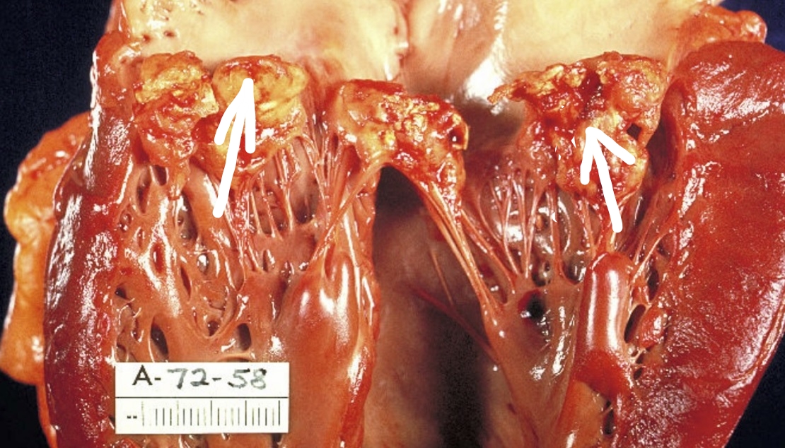 What is acute bacterial endocarditis, and what are its common causes?