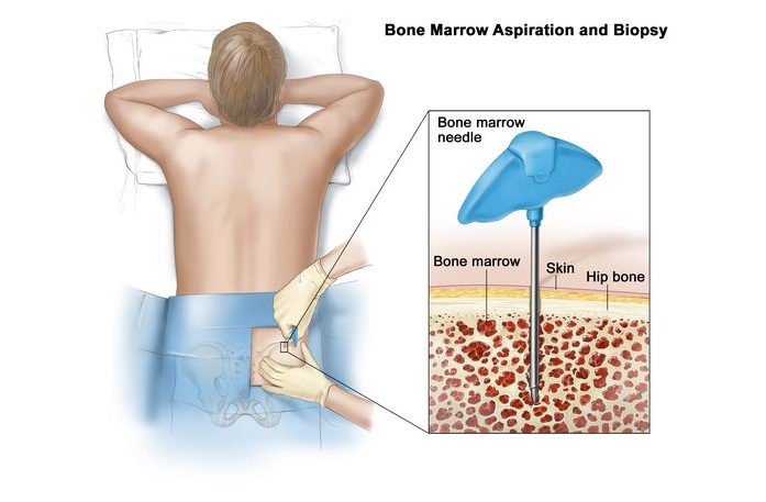 What is the difference between bone marrow aspiration and biopsy