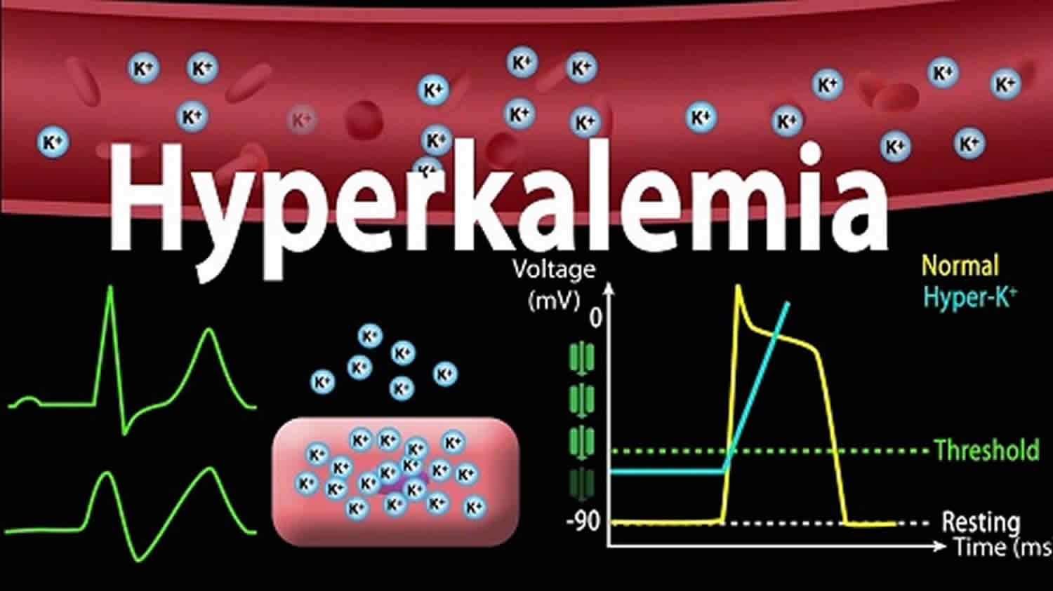 NCLEX Practice Quiz: Sodium Polystyrene Sulfonate for Hyperkalemia