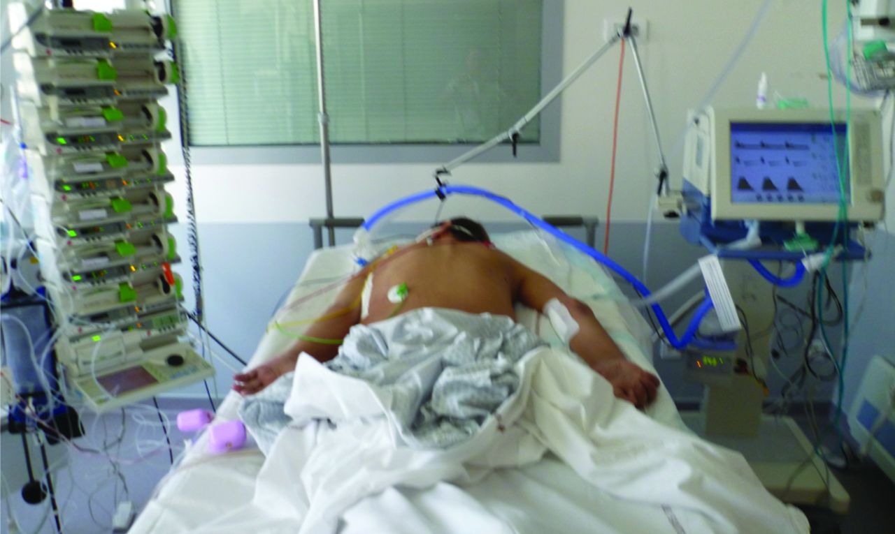 NCLEX Practice Quiz: Indications for Ventilator Support for ARDS