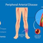 NCLEX Practice Quiz on CLTI & PAT