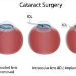 Nursing Priority for Instilling Eye Drops Before Cataract Removal
