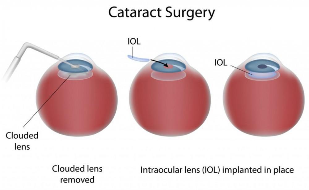 NCLEX Review Quiz: Cataract Removal and Eye Drop Administration