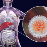 The Most Important Electrolyte Abnormality to Monitor in Patients with Hepatitis C after Liver Resection