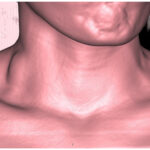 Saccular aneurysm of external jugular vein with partial thrombosis