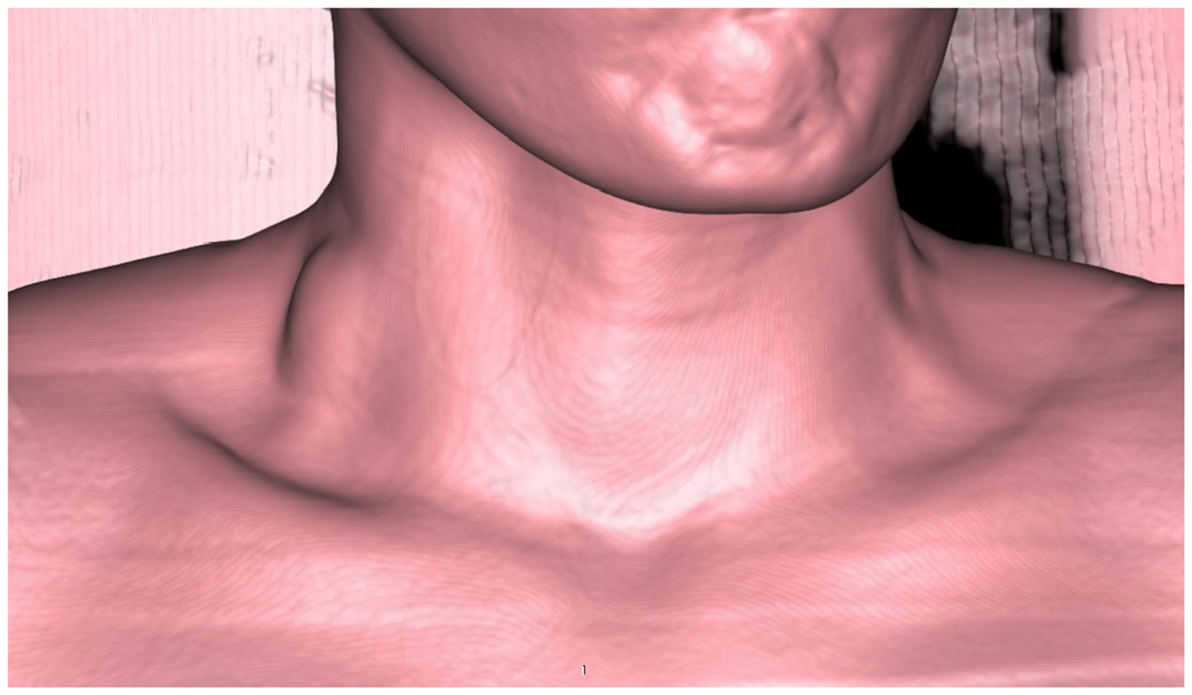 Saccular aneurysm of external jugular vein with partial thrombosis