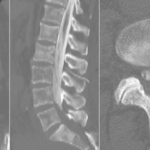 Positioning the Patient After Myelography