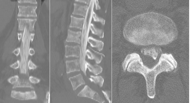 Positioning the Patient After Myelography