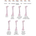 Types of Bone Fractures