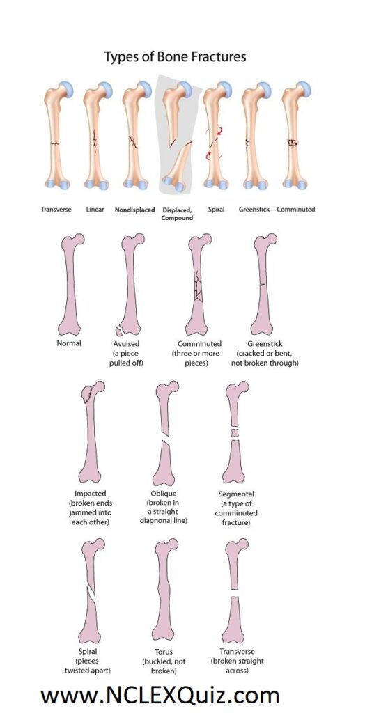 Types of Bone Fractures