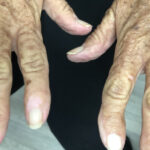 addison disease