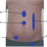 NCLEX-RN Question on Spigelian Hernia