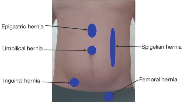 NCLEX-RN Question on Assessing a Client with a Herniated Abdomen