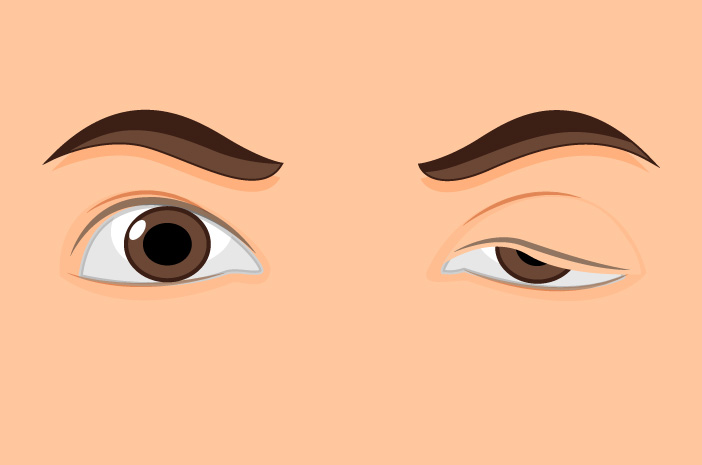 NCLEX Nursing Quiz: Care of the Patient with Myasthenia Gravis
