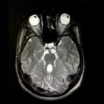 Tonic-Clonic (Grand Mal) Seizures