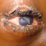 Immediate Interventions for Eyeball Contusion