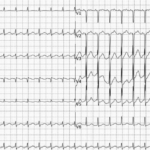 NCLEX Quiz: Assessment of Atrial Fibrillation Symptoms