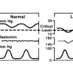 Nurse reviewing fetal heart rate monitor showing late decelerations during a contraction stress test in a pregnant woman.