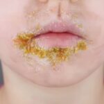 Identification of Honey-Colored Crusted Lesions in Pediatric Clients
